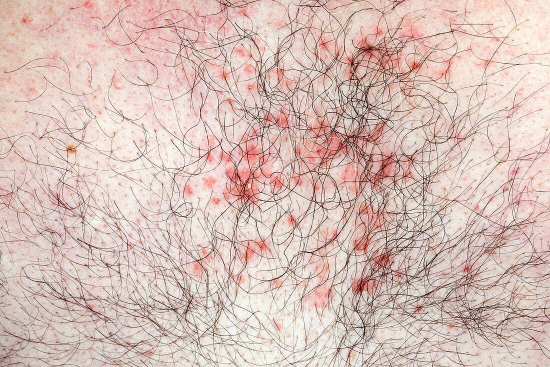 Folliculitis of the chest