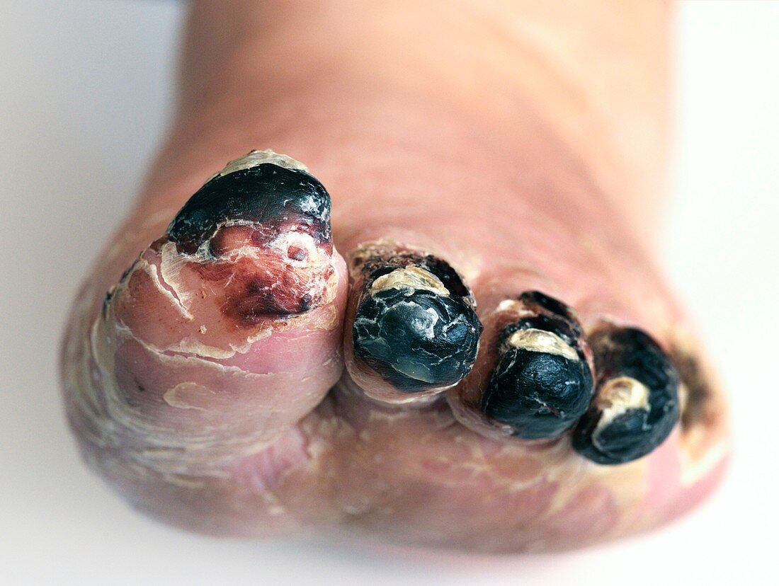 Gangrenous toes in diabetes