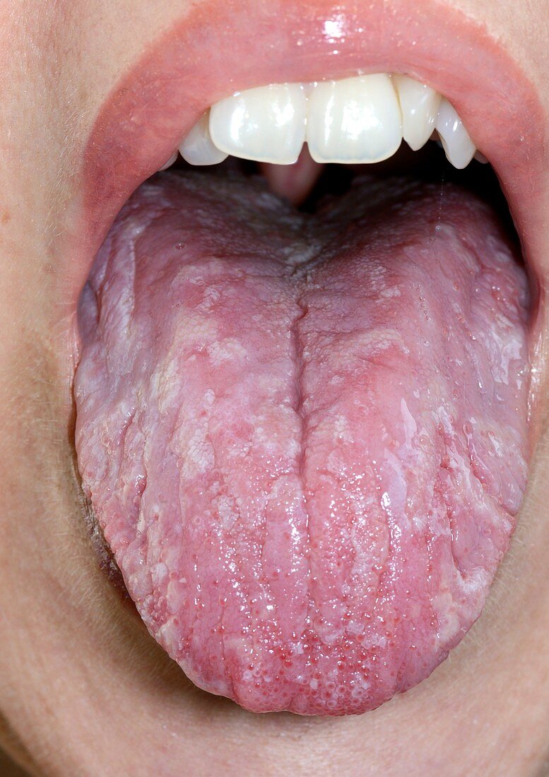 Inflamed tongue in iron deficiency
