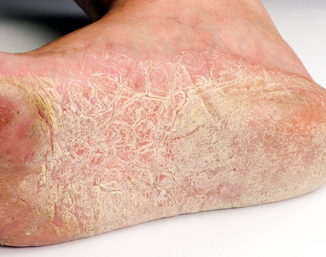 Eczema of the foot