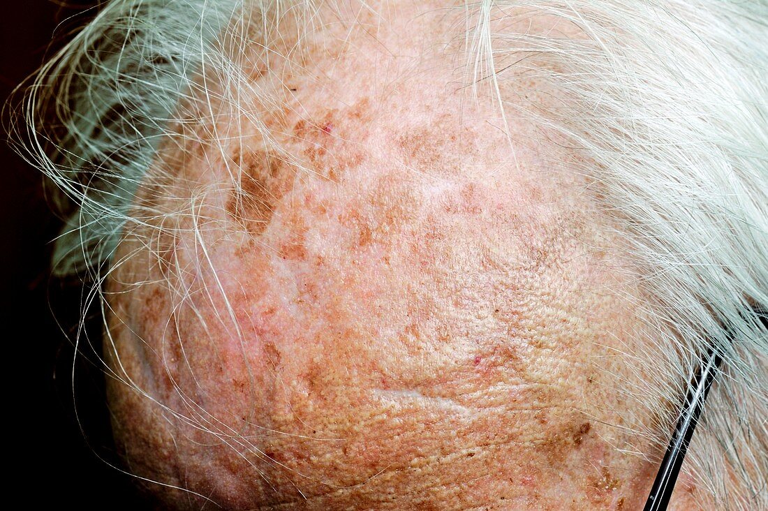 Solar keratosis of the scalp