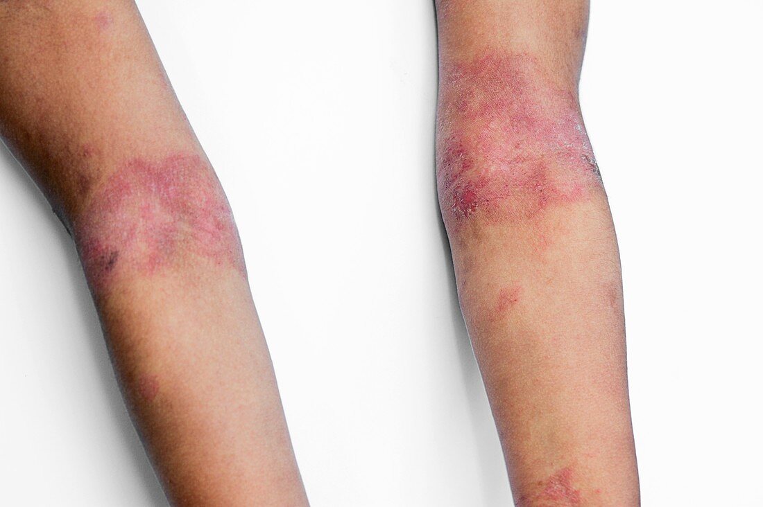 Eczema of the elbows