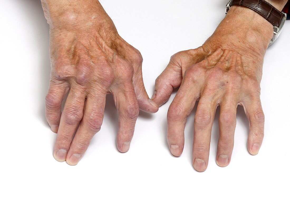 Rheumatoid arthritis of the hands