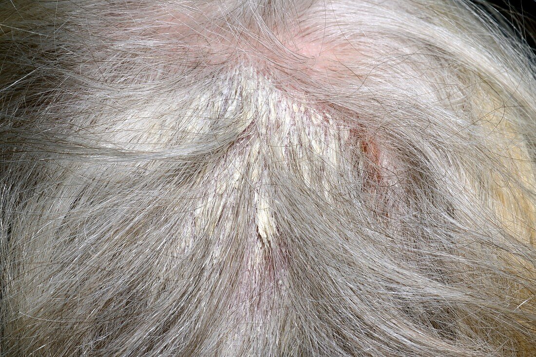 Psoriasis of the scalp