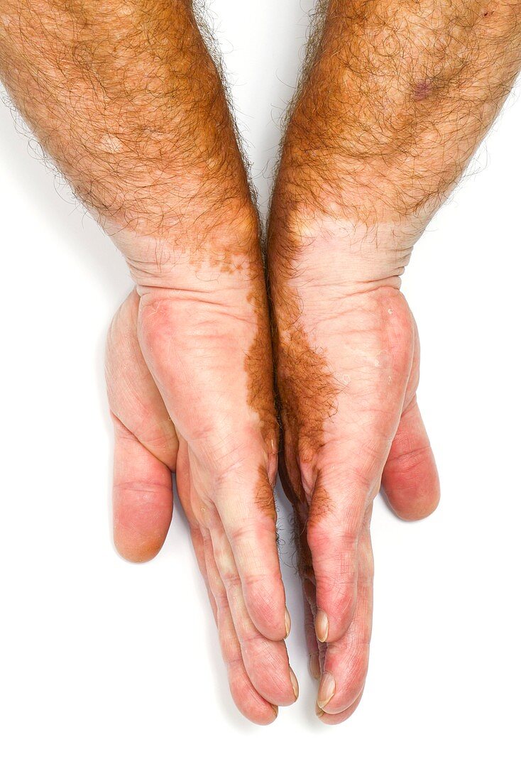 Vitiligo of the hands