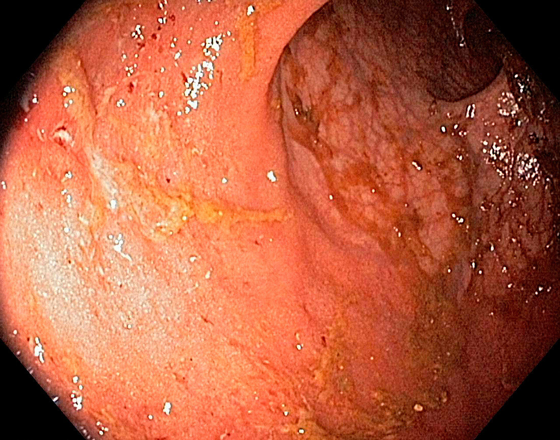 Ulcerative proctitis,endoscope view