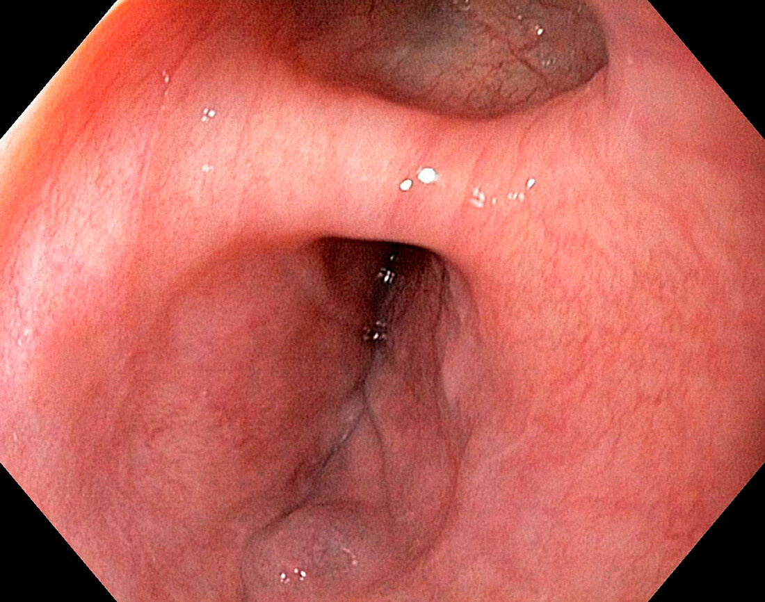 Oesophageal diverticulitis