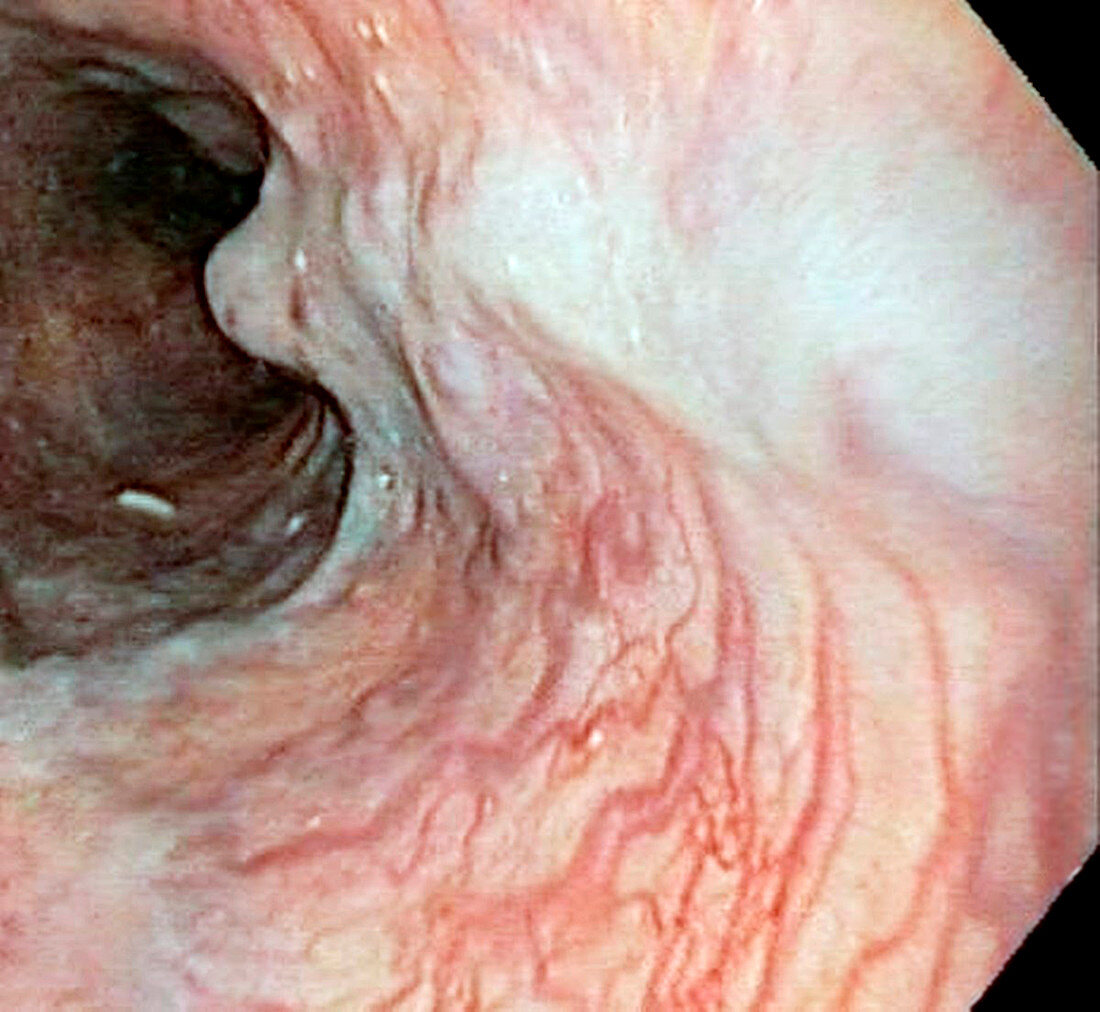 Oesophageal varices,endoscope view