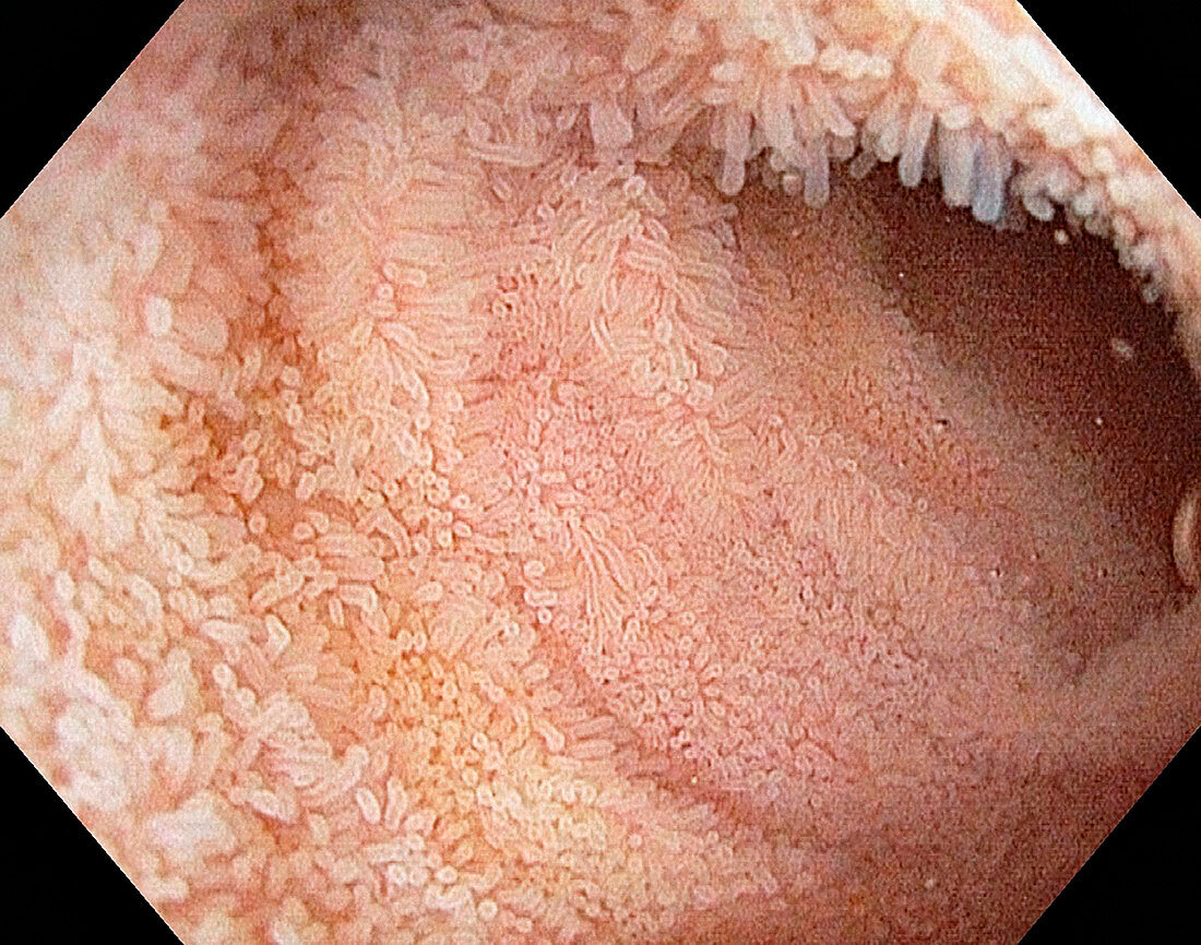 Terminal ileum,endoscope view