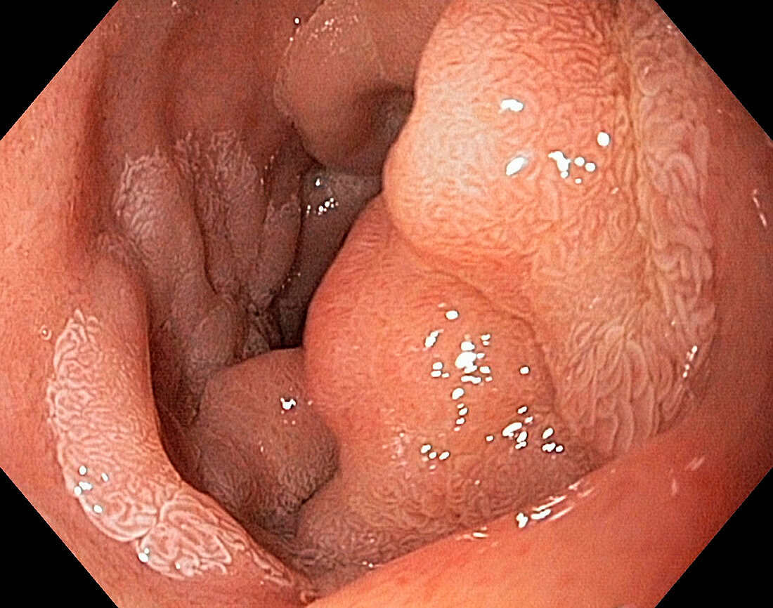 Intestinal polyp,endoscope view