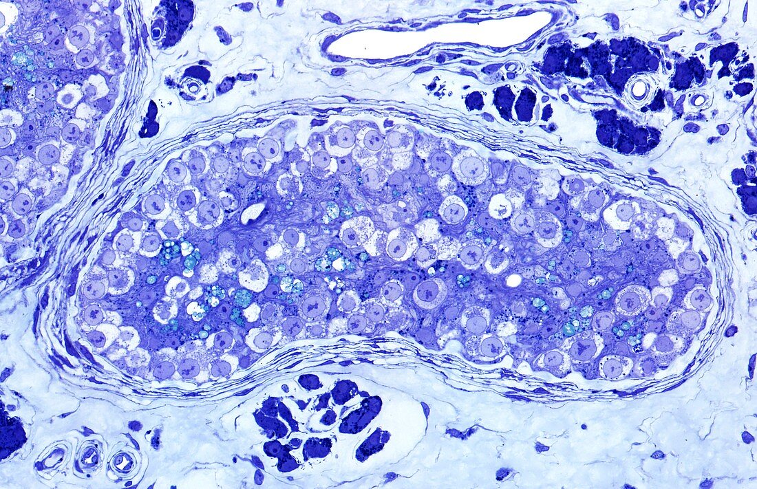 Human testis cancer,light micrograph