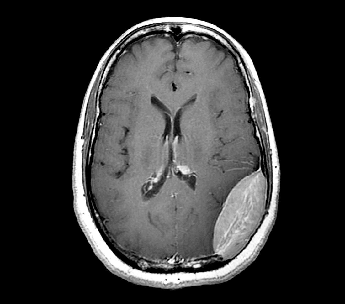 Brain cancer,MRI