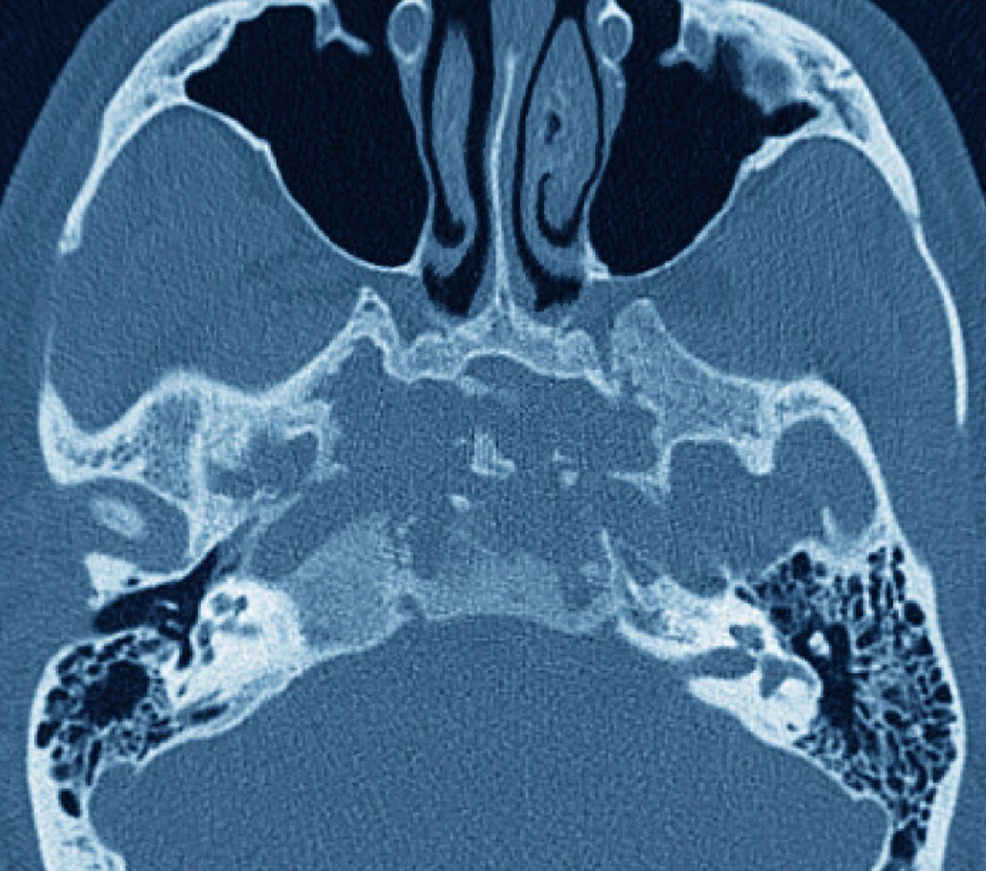 Skull in Erdheim-Chester disease,MRI