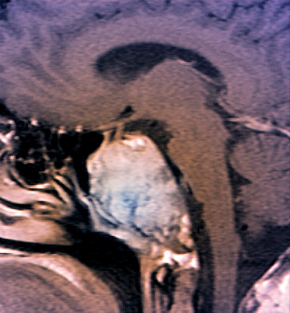 Skull in Erdheim-Chester disease,MRI