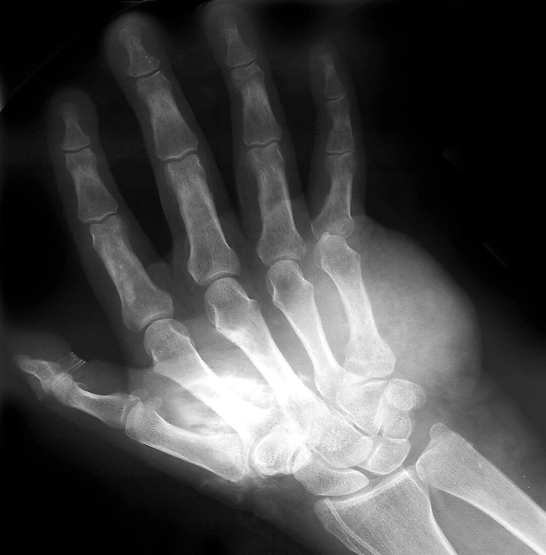 Hand tumour,X-ray