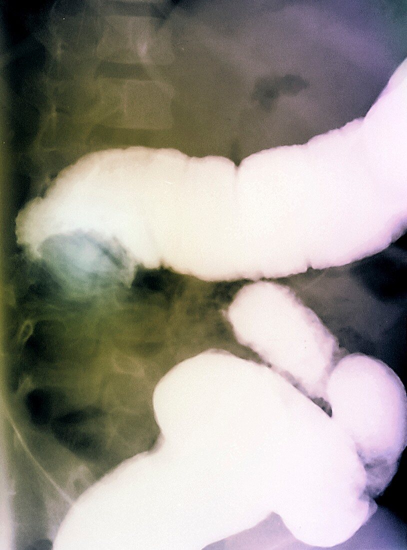 Intussusception of the intestines,X-ray