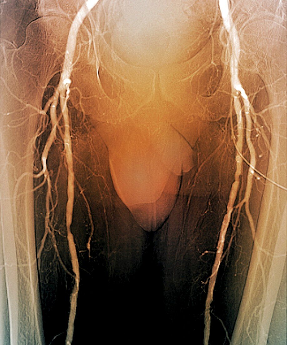 Arteritis in diabetes,X-ray