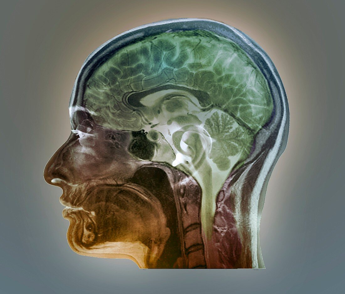 Brain anatomy,MRI