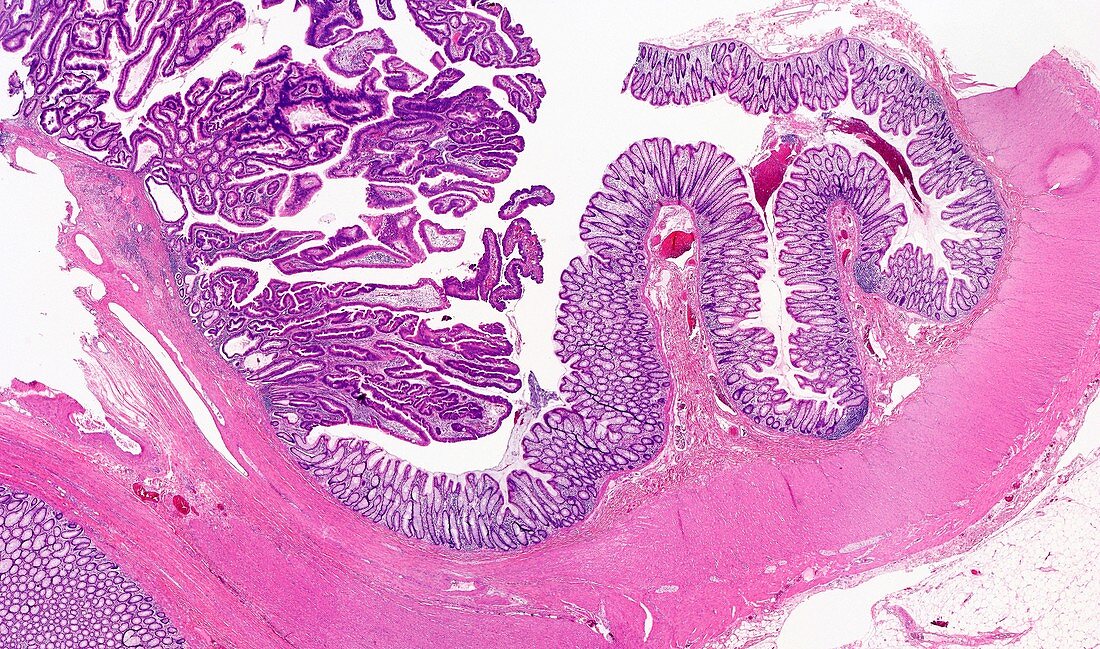 Large bowel tumour,light micrograph