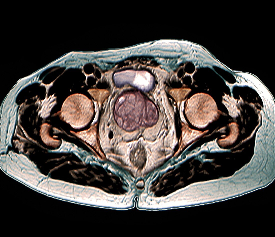 Benign prostatic hyperplasia,MRI