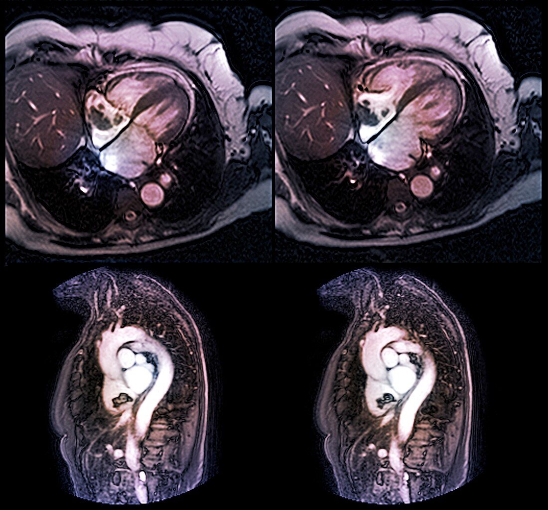 Lung cancer,MRI