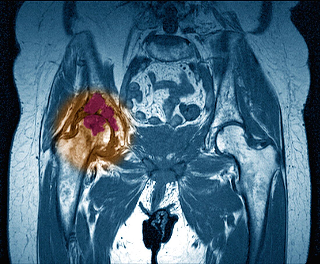 Osteonecrosis of the pelvis,MRI