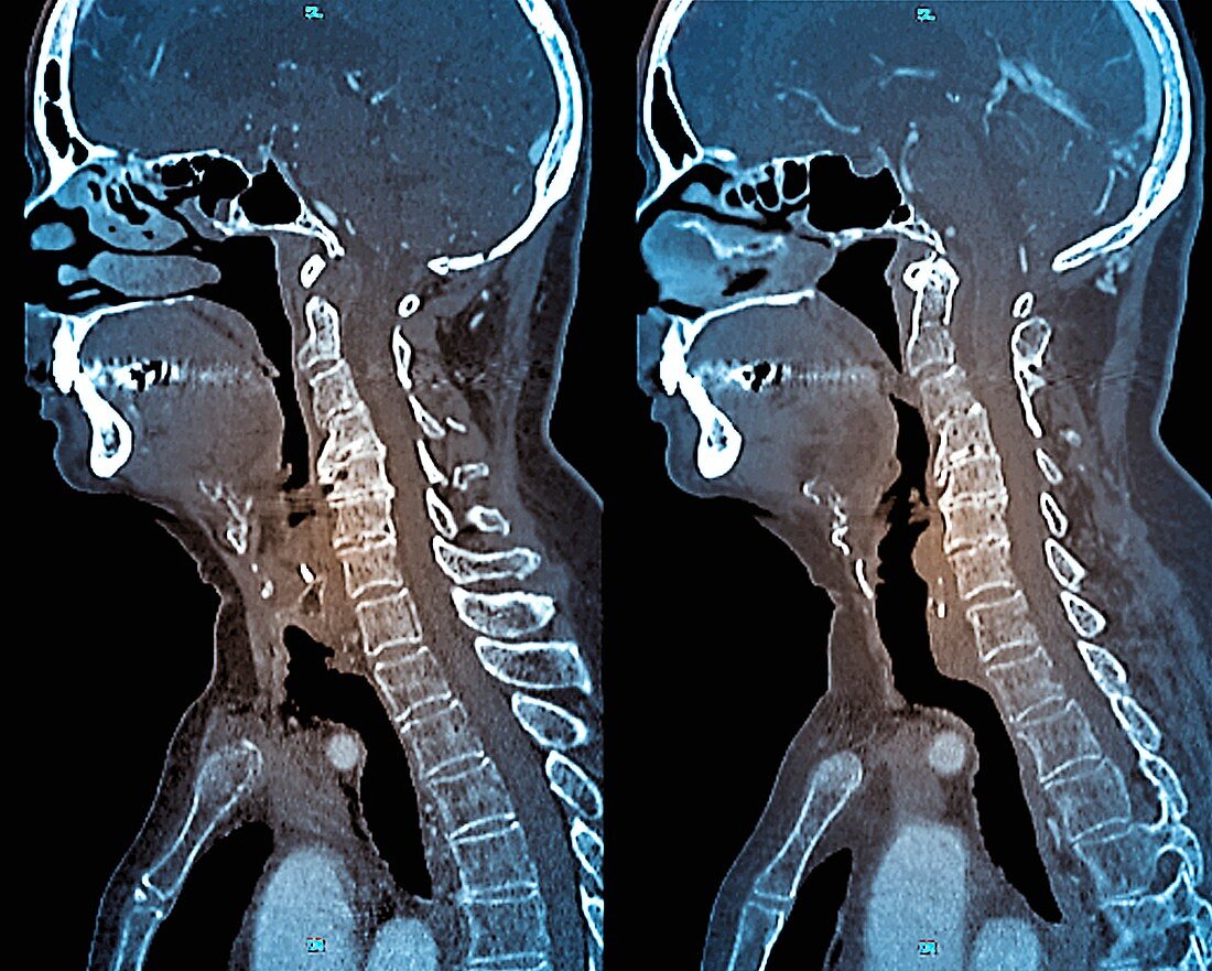 Osteoarthritis of the neck,CT scans