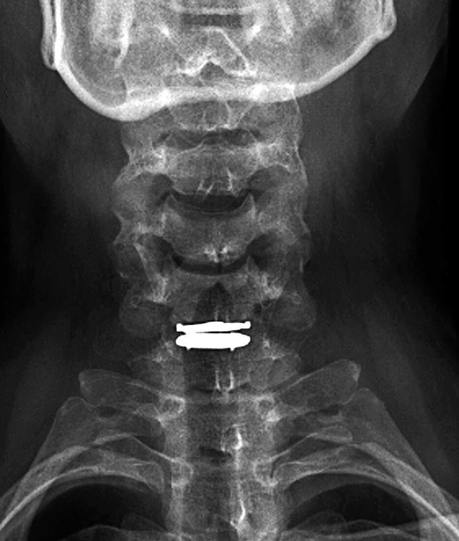 Spinal disc implant,X-ray