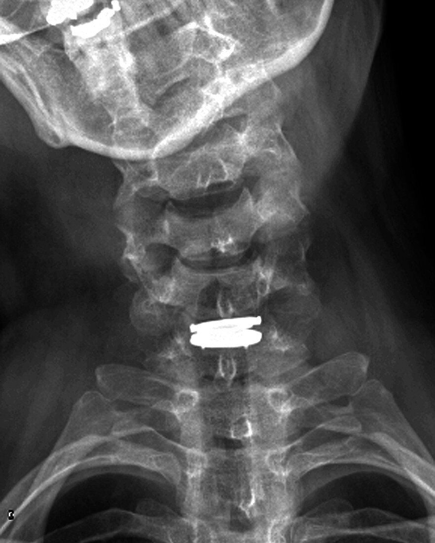 Spinal disc implant,X-ray