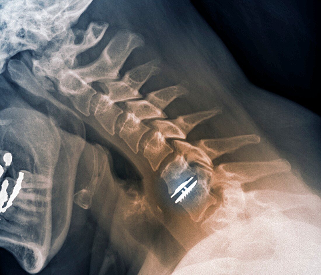 Spinal disc implant,X-ray