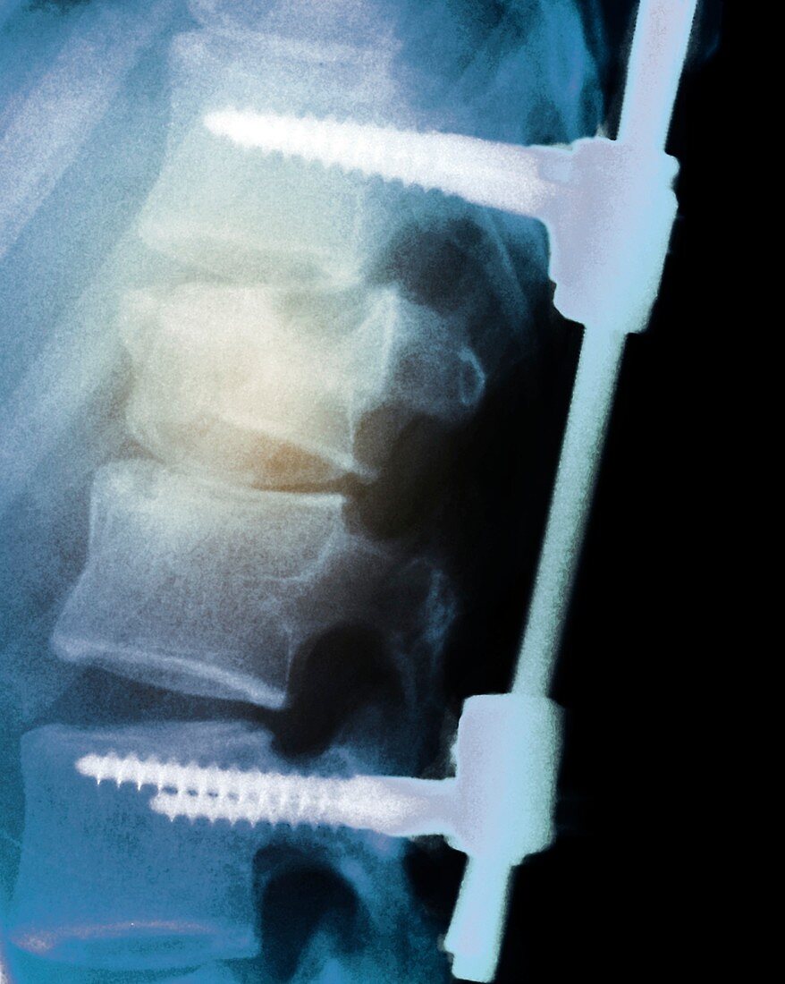 Pinned backbone,X-ray