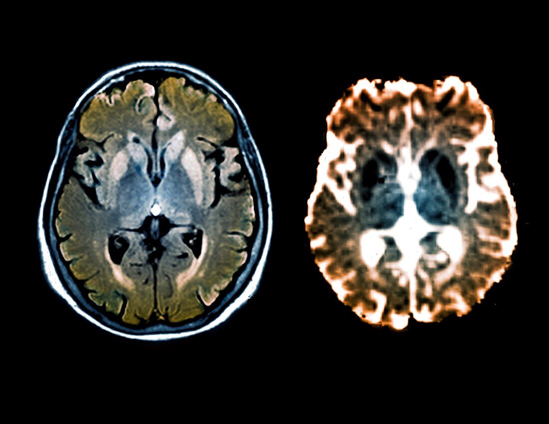 Brain in Creutzfeldt-Jakob disease,MRI