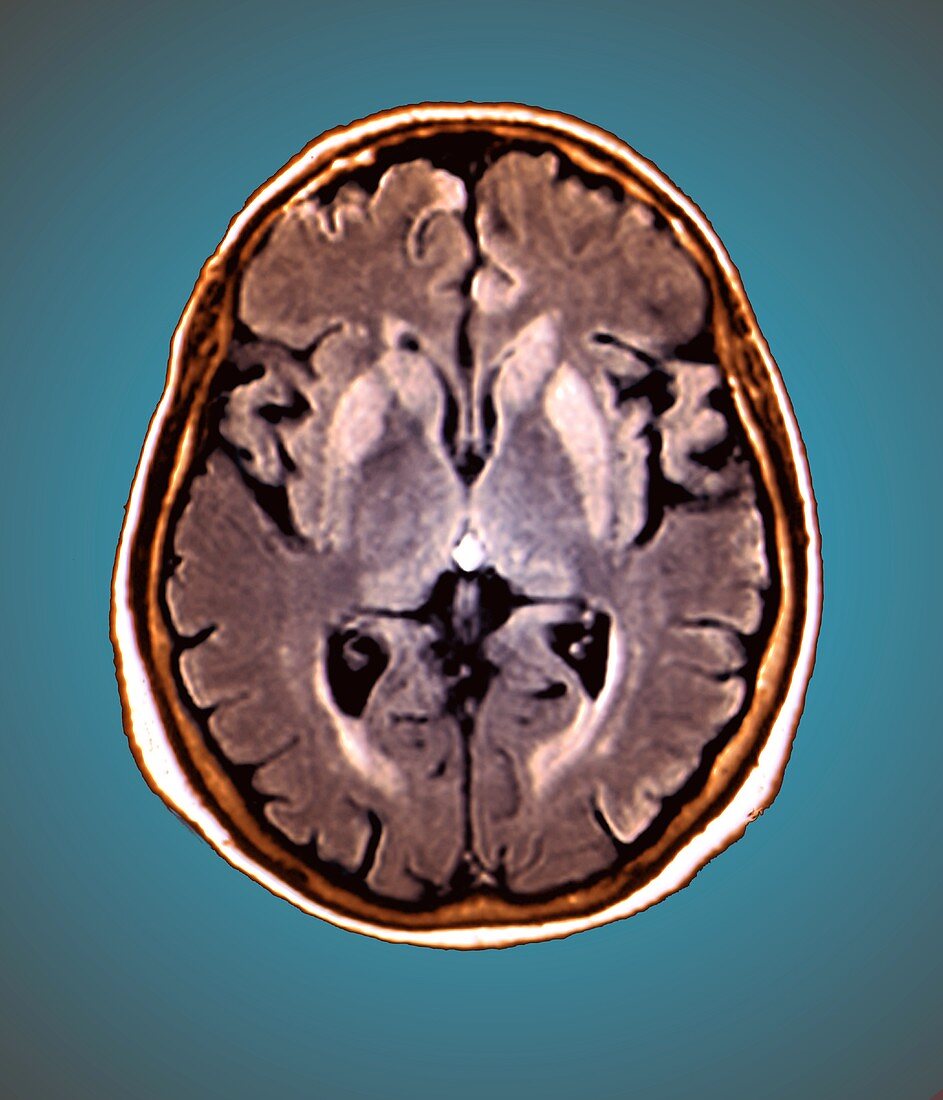 Brain in Creutzfeldt-Jakob disease,MRI