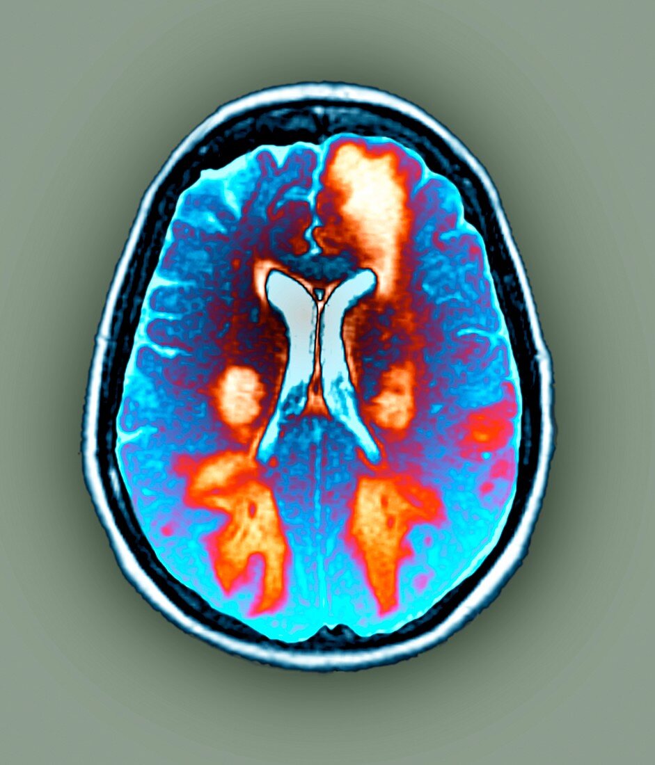 Brain in toxic encephalopathy,MRI