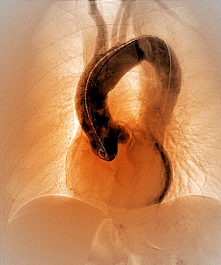 Aortic aneurysm in hypertension,X-ray