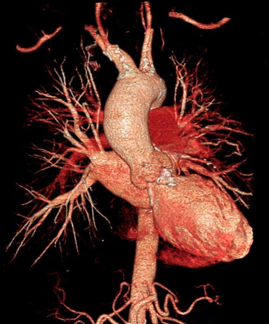 Aortic aneurysm in hypertension,CT scan