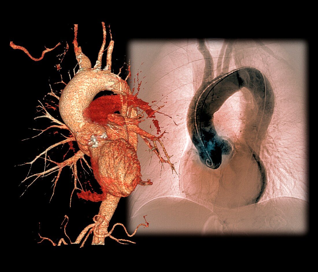 Aortic aneurysm in hypertension