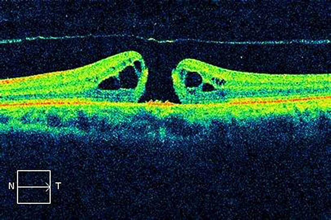Macular hole,OCT scan