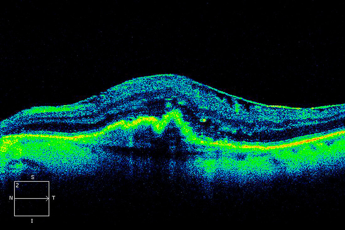 Macular degeneration,OCT scan