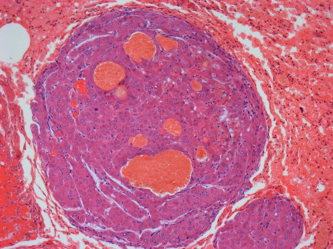 Metastatic liver cancer,light micrograph