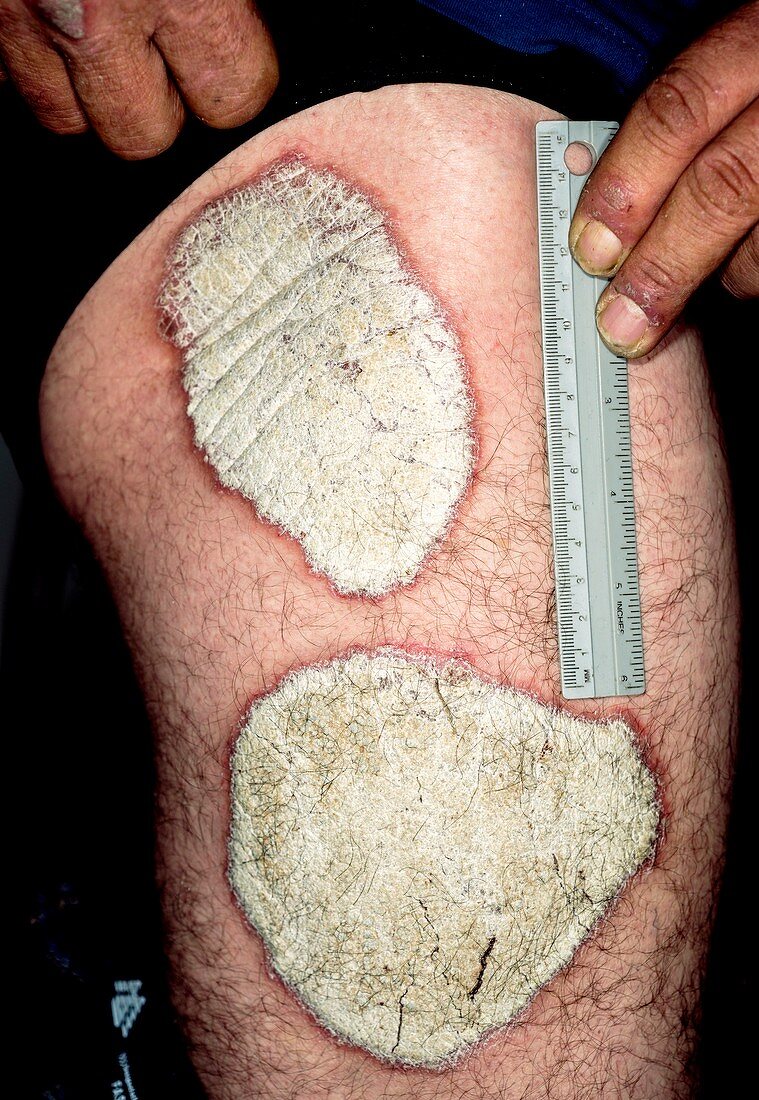 Ostraceous psoriasis
