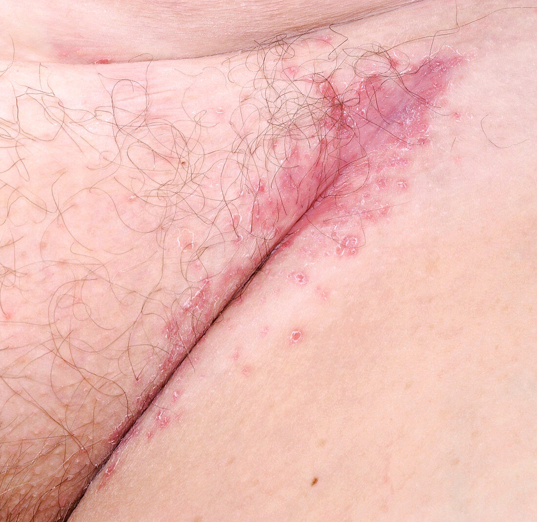 Flexural psoriasis of a groin cleft