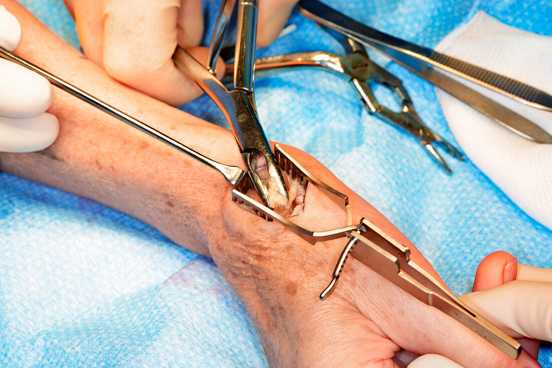 Trapeziumectomy wrist operation
