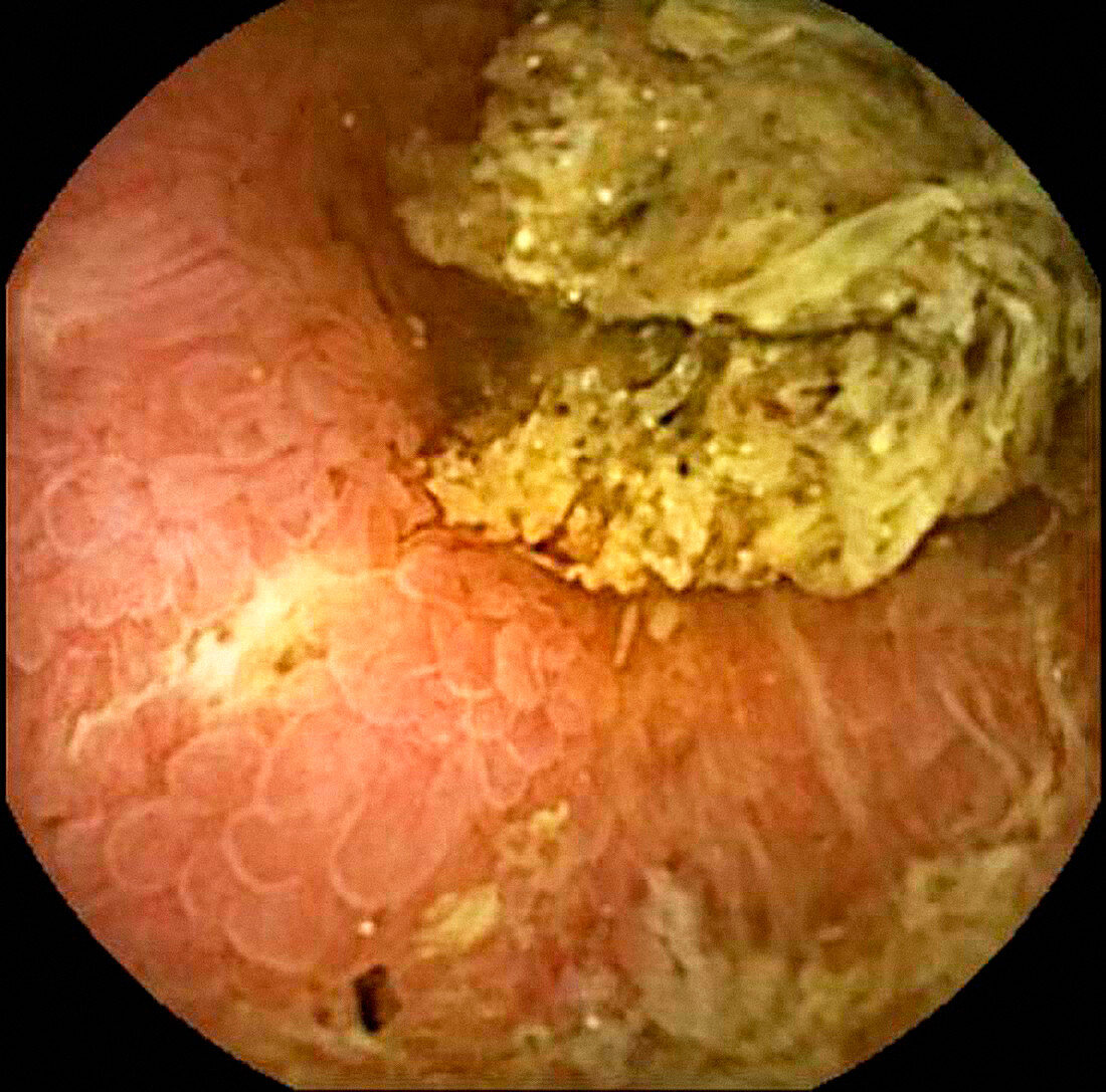 Crohn's disease,capsule endoscopy