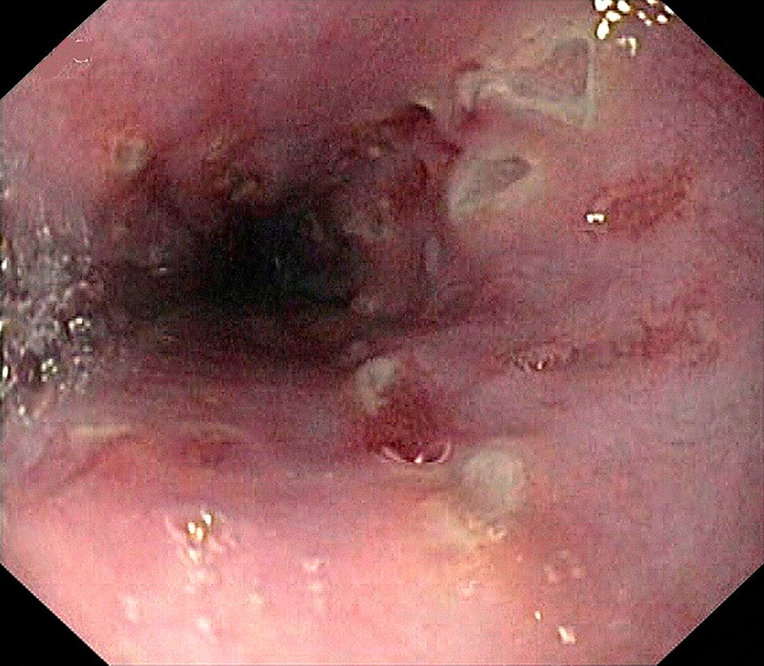 Oesophageal Crohn's disease,endoscopy
