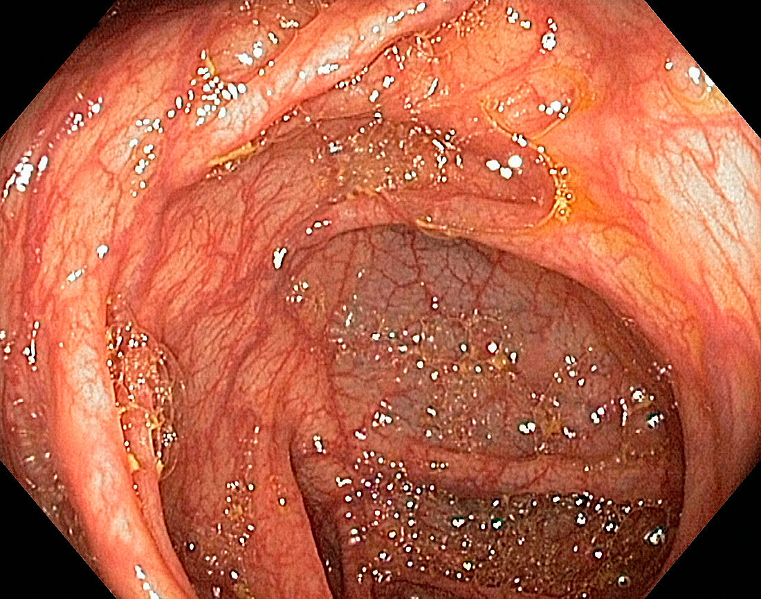 Hepatic flexure of the colon,endoscopy