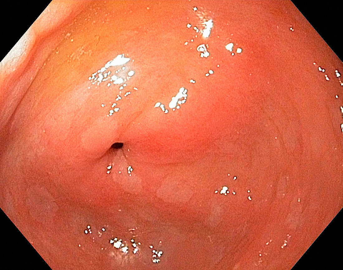 Intestinal metaplasia of the stomach