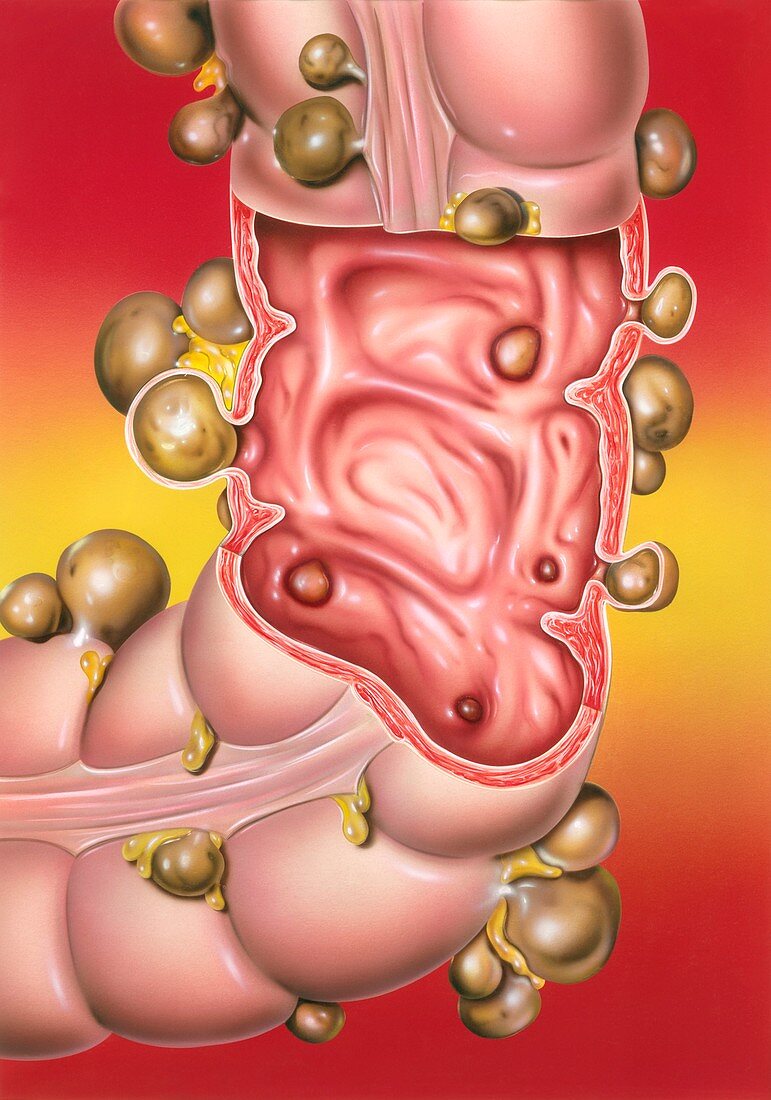 Diverticular disease,illustration