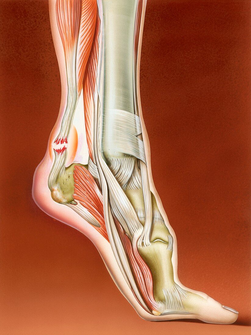 Achilles tendon rupture,illustration