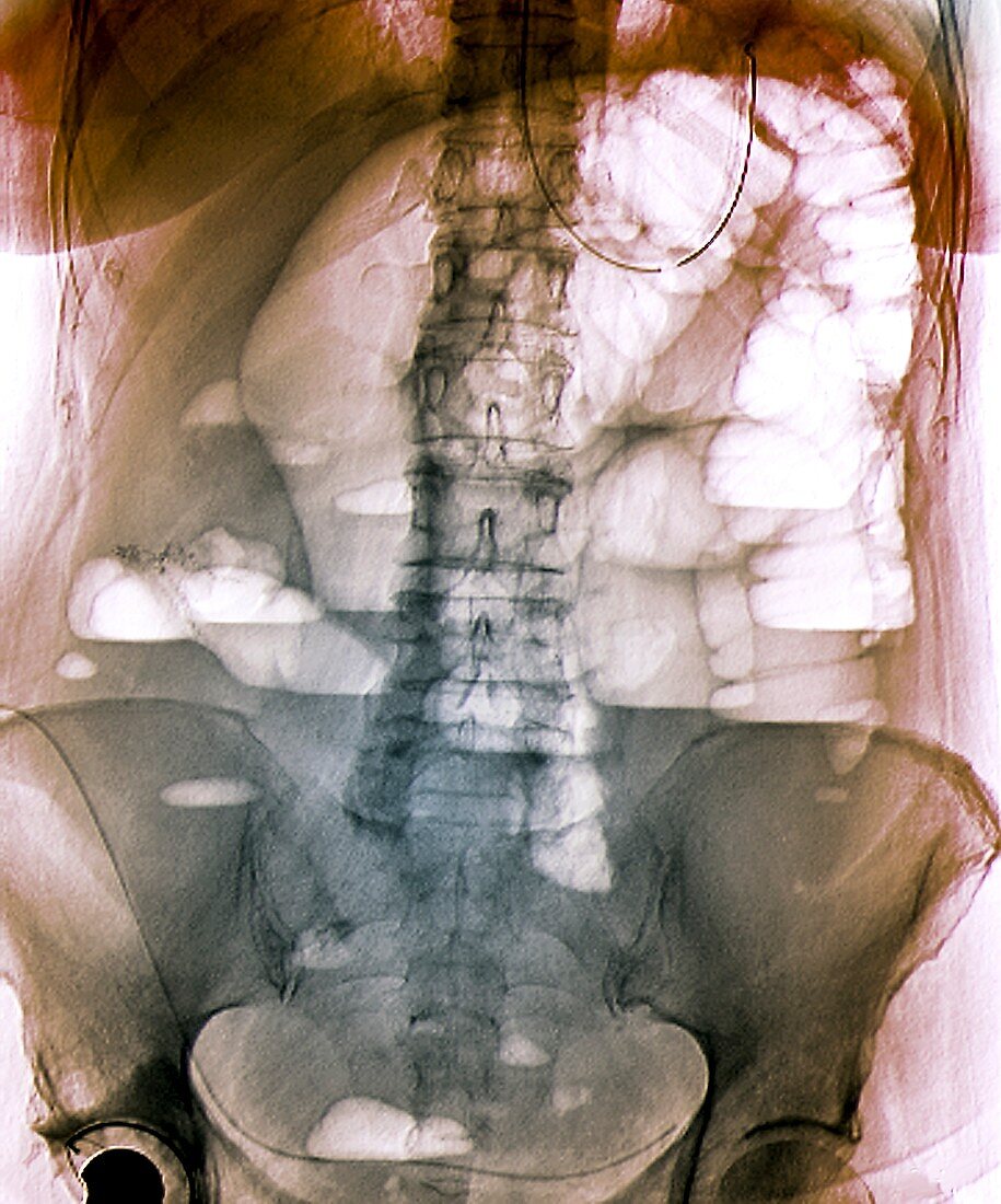 Abdominal blockage,X-ray